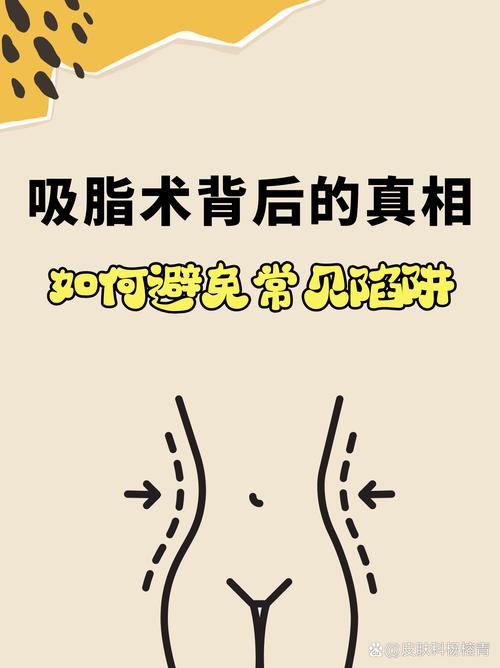 抽脂手术的原理、常见部位及全身吸脂的原则与注意事项