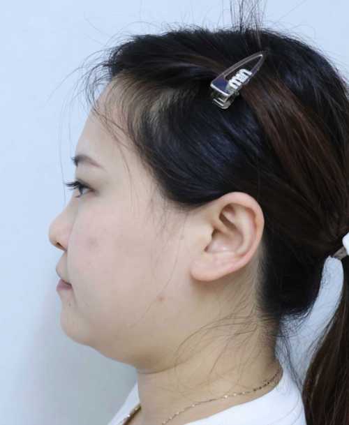 上饶面部微吸脂术后多久能看到效果？这些因素要知晓