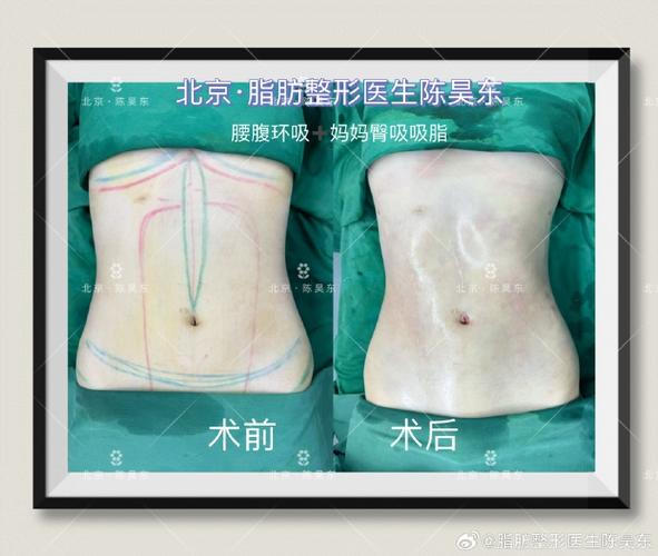 FSN吸脂技术_保留纤维隔膜网组织吸脂_腹部抽脂后会反弹吗
